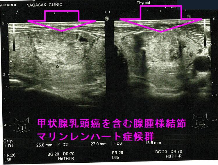 甲状腺乳頭癌を含む腺腫様結節、マリンレンハート症候群3 甲状腺乳頭癌を含む腺腫様結節、マリンレンハート症候群3
