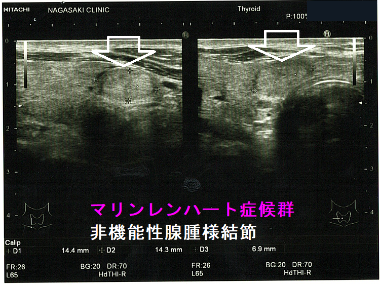 甲状腺乳頭癌を含む腺腫様結節、マリンレンハート症候群 非機能性腺腫様結節部分 甲状腺乳頭癌を含む腺腫様結節、マリンレンハート症候群 非機能性腺腫様結節部分