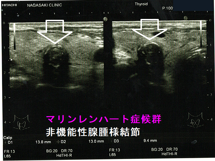 甲状腺乳頭癌を含む腺腫様結節、マリンレンハート症候群3 マリンレンハート症候群 非機能性腺腫様結節3