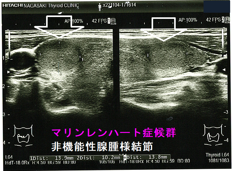 マリンレンハート症候群 非機能性腺腫様結節4 マリンレンハート症候群 非機能性腺腫様結節4