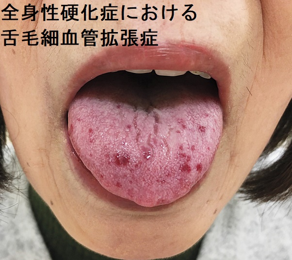 全身性硬化症における舌毛細血管拡張症 全身性硬化症における舌毛細血管拡張症