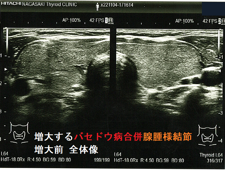 増大するバセドウ病合併腺腫様結節 増大前 全体像 増大するバセドウ病合併腺腫様結節 増大前 全体像