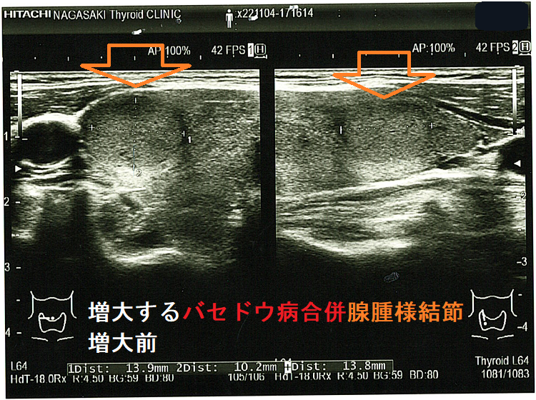 増大するバセドウ病合併腺腫様結節 増大前2 増大するバセドウ病合併腺腫様結節 増大前2