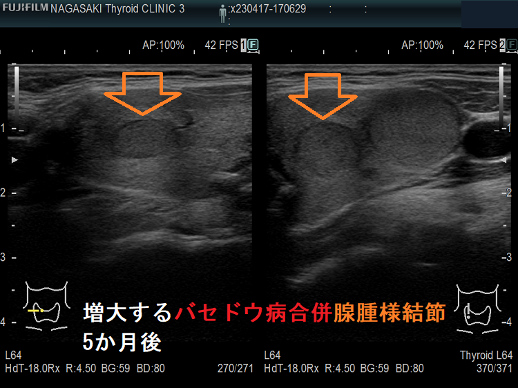 増大するバセドウ病合併腺腫様結節1 増大するバセドウ病合併腺腫様結節1
