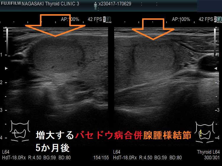 増大するバセドウ病合併腺腫様結節2 増大するバセドウ病合併腺腫様結節2