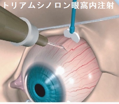 トリアムシノロン(トリアムシノロンアセトニド)眼窩内注射 トリアムシノロン(トリアムシノロンアセトニド)眼窩内注射