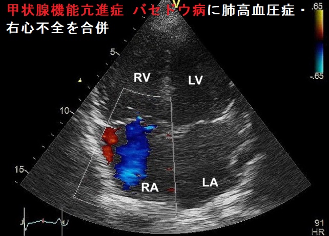 甲状腺機能亢進症 バセドウ病に肺高血圧症・右心不全を合併 甲状腺機能亢進症 バセドウ病に肺高血圧症・右心不全を合併