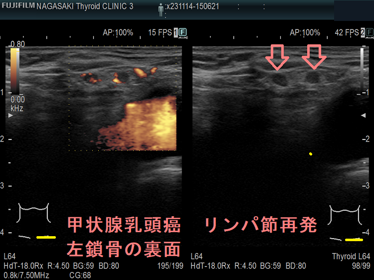甲状腺乳頭癌 リンパ節再発 左鎖骨の裏面 甲状腺乳頭癌 リンパ節再発 左鎖骨の裏面