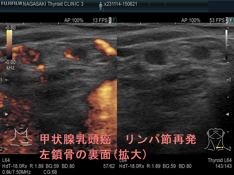 甲状腺乳頭癌 リンパ節再発 左鎖骨の裏面(拡大) 甲状腺乳頭癌 リンパ節再発 左鎖骨の裏面(拡大)