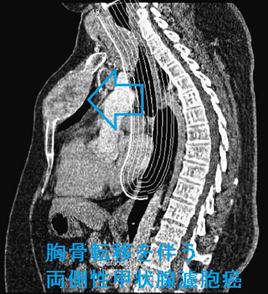 胸骨転移を伴う両側性甲状腺濾胞癌 胸骨転移を伴う両側性甲状腺濾胞癌