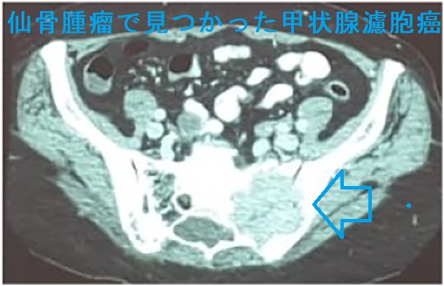仙骨腫瘤で見つかった甲状腺濾胞癌 仙骨腫瘤で見つかった甲状腺濾胞癌