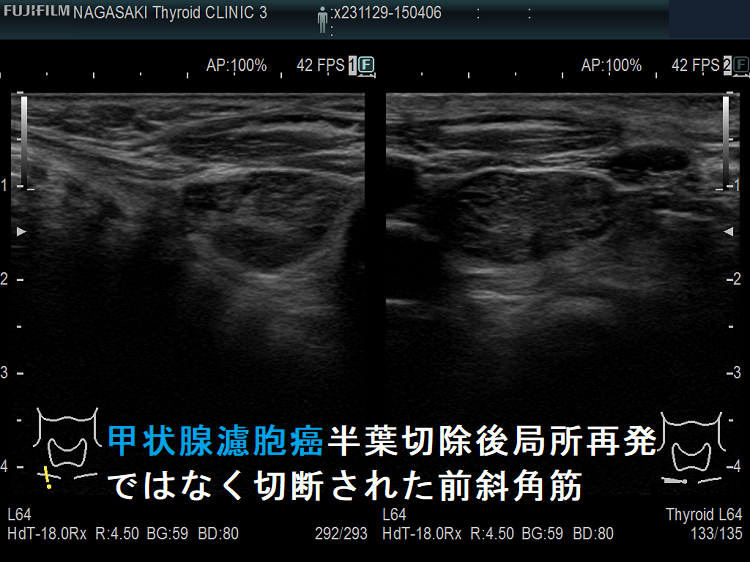 甲状腺濾胞癌半葉切除後局所再発ではなく切断された前斜角筋 甲状腺濾胞癌半葉切除後局所再発ではなく切断された前斜角筋