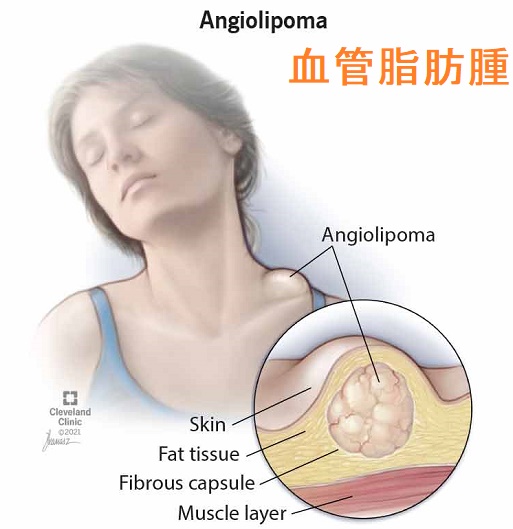 頚部 血管脂肪腫 頚部 血管脂肪腫