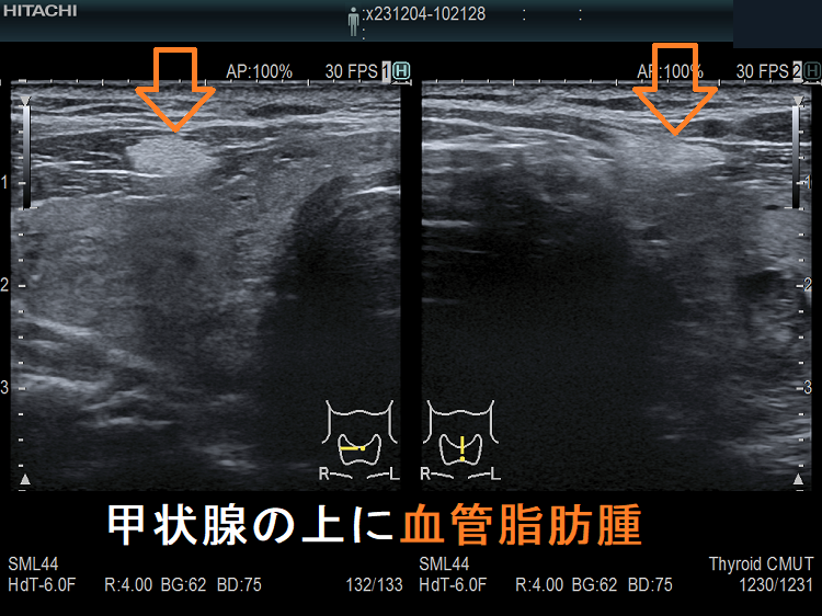 甲状腺の上に血管脂肪腫 超音波(エコー)画像 甲状腺の上に血管脂肪腫 超音波(エコー)画像