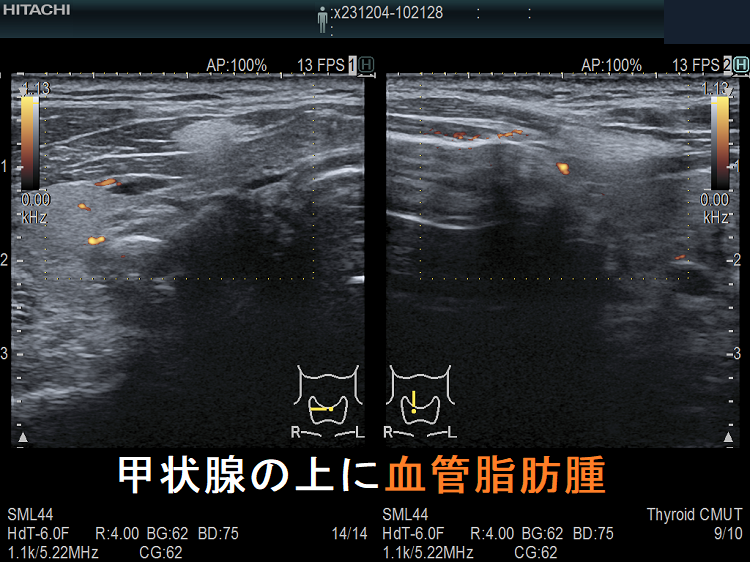 甲状腺の上に血管脂肪腫 超音波(エコー)画像 ドプラーモード 甲状腺の上に血管脂肪腫 超音波(エコー)画像 ドプラーモード