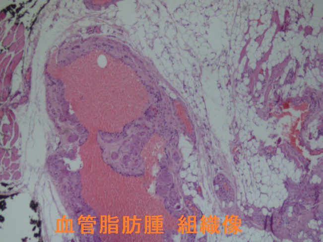 血管脂肪腫 組織像2 血管脂肪腫 組織像2