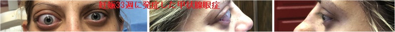 妊娠33週に眼瞼下垂・眼球運動障害・眼痛で発症した甲状腺眼症 妊娠33週に眼瞼下垂・眼球運動障害・眼痛で発症した甲状腺眼症