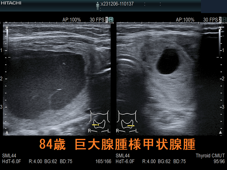 84歳 巨大腺腫様甲状腺腫 84歳 巨大腺腫様甲状腺腫