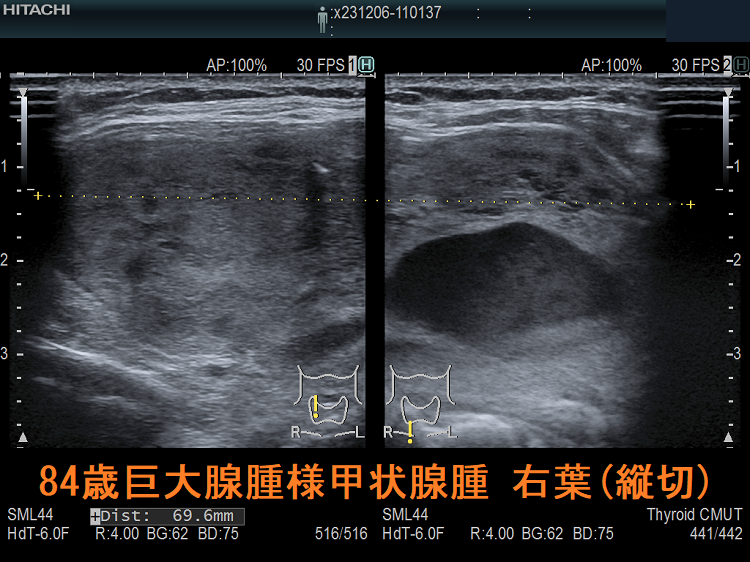 84歳 巨大腺腫様甲状腺腫 右葉(縦切) 84歳 巨大腺腫様甲状腺腫 右葉(縦切)