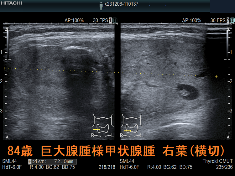84歳 巨大腺腫様甲状腺腫 右葉(横切) 84歳 巨大腺腫様甲状腺腫 右葉(横切)