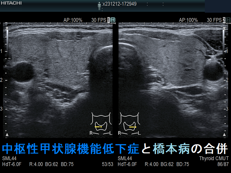 中枢性甲状腺機能低下症と橋本病の合併(水平断) 中枢性甲状腺機能低下症と橋本病の合併(水平断)