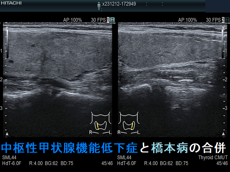 中枢性甲状腺機能低下症と橋本病の合併(垂直断) 中枢性甲状腺機能低下症と橋本病の合併(垂直断)