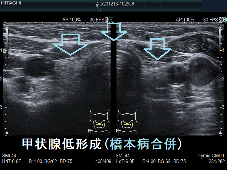 甲状腺低形成(橋本病合併) 甲状腺低形成(橋本病合併)