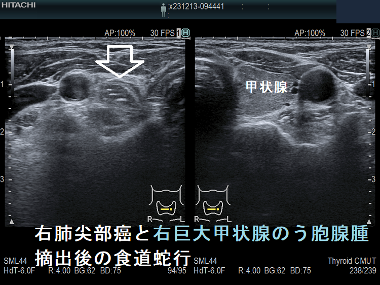 右肺尖部癌と右巨大甲状腺のう胞腺腫で右半葉摘出後の食道蛇行(水平断) 右肺尖部癌と右巨大甲状腺のう胞腺腫で右半葉摘出後の食道蛇行(水平断)