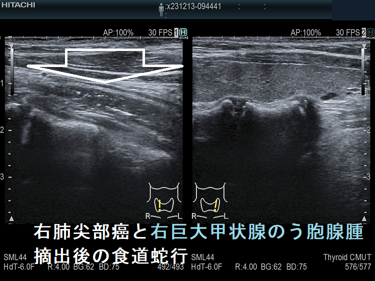 右肺尖部癌と右巨大甲状腺のう胞腺腫摘出後の食道蛇行(垂直断) 右肺尖部癌と右巨大甲状腺のう胞腺腫摘出後の食道蛇行(垂直断)