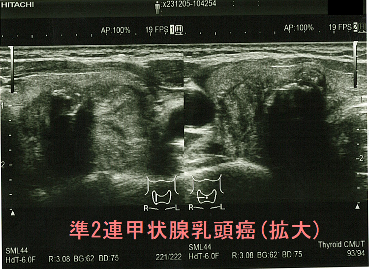 準2連甲状腺乳頭癌(拡大) 準2連甲状腺乳頭癌(拡大)