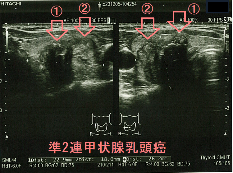 準2連甲状腺乳頭癌 準2連甲状腺乳頭癌1