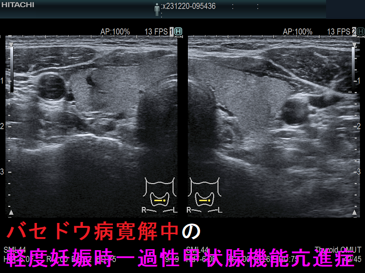 バセドウ病寛解中の軽度妊娠時一過性甲状腺機能亢進症 バセドウ病寛解中の軽度妊娠時一過性甲状腺機能亢進症