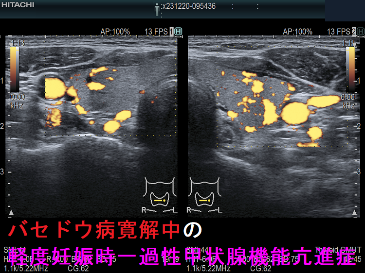 バセドウ病寛解中の軽度妊娠時一過性甲状腺機能亢進症 ドプラーモード バセドウ病寛解中の軽度妊娠時一過性甲状腺機能亢進症 ドプラーモード