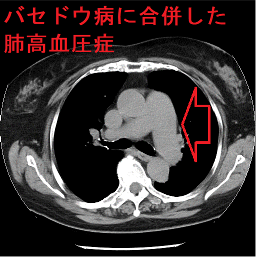 バセドウ病に合併した肺高血圧症 単純CT画像 バセドウ病に合併した肺高血圧症 単純CT画像