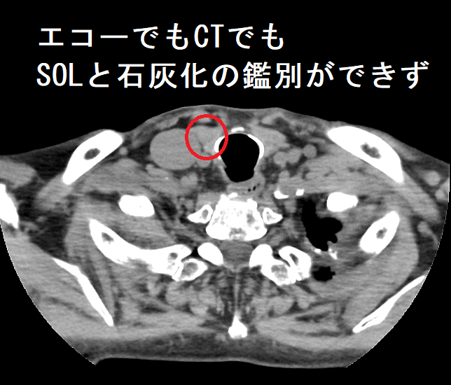 エコーでもCTでもSOLと石灰化の鑑別ができず CT画像(横断) エコーでもCTでもSOLと石灰化の鑑別ができず CT画像(横断)