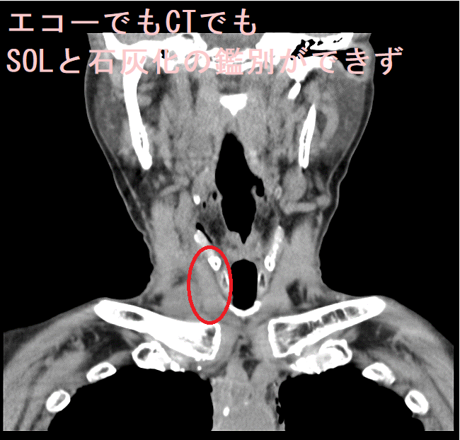 エコーでもCTでもSOLと石灰化の鑑別ができず CT画像(縦断:正面) エコーでもCTでもSOLと石灰化の鑑別ができず CT画像(縦断:正面)