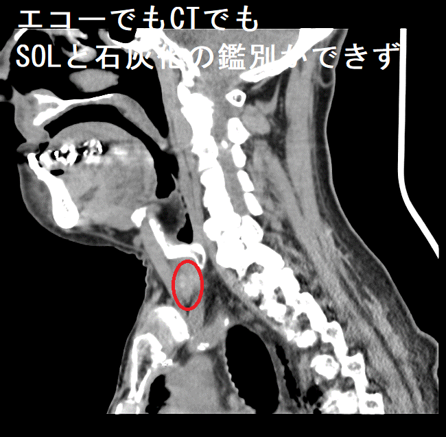 エコーでもCTでもSOLと石灰化の鑑別ができず CT画像(縦断:側面) エコーでもCTでもSOLと石灰化の鑑別ができず CT画像(縦断:側面)