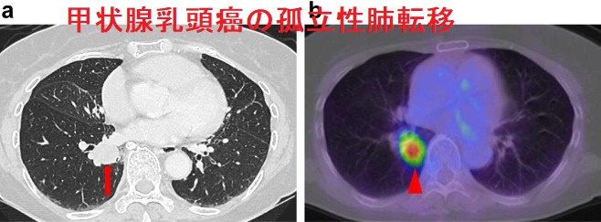 甲状腺乳頭癌の孤立性肺転移 甲状腺乳頭癌の孤立性肺転移