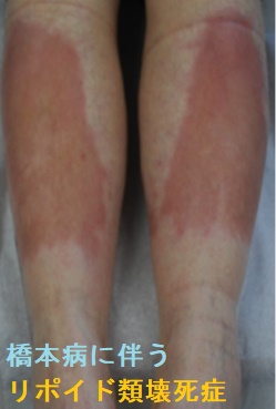 橋本病(慢性甲状腺炎)に伴うリポイド類壊死症1 橋本病(慢性甲状腺炎)に伴うリポイド類壊死症1