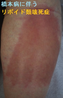 橋本病(慢性甲状腺炎)に伴うリポイド類壊死症2 橋本病(慢性甲状腺炎)に伴うリポイド類壊死症2