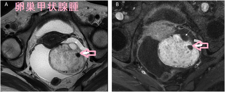 卵巣甲状腺腫 MRI T2 画像 造影脂肪飽和T1画像 卵巣甲状腺腫 MRI T2 画像 造影脂肪飽和T1画像