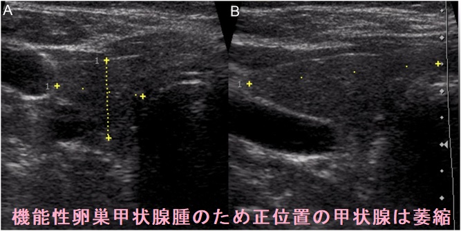 機能性卵巣甲状腺腫のため正位置の甲状腺は萎縮 機能性卵巣甲状腺腫のため正位置の甲状腺は萎縮