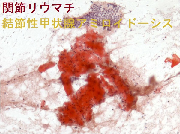 関節リウマチ 結節性甲状腺アミロイドーシス 細胞診 関節リウマチ 結節性甲状腺アミロイドーシス 細胞診