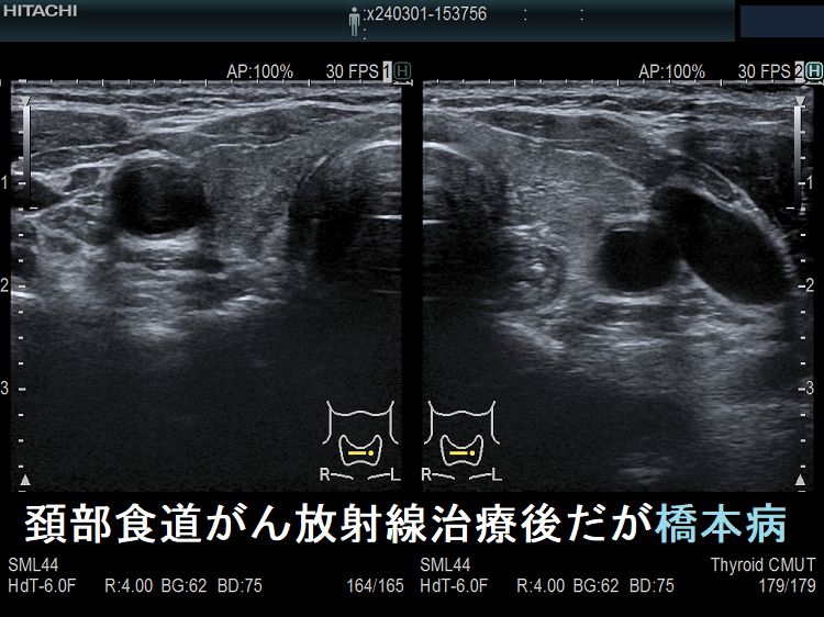 頚部食道がん放射線治療後だが橋本病 頚部食道がん放射線治療後だが橋本病