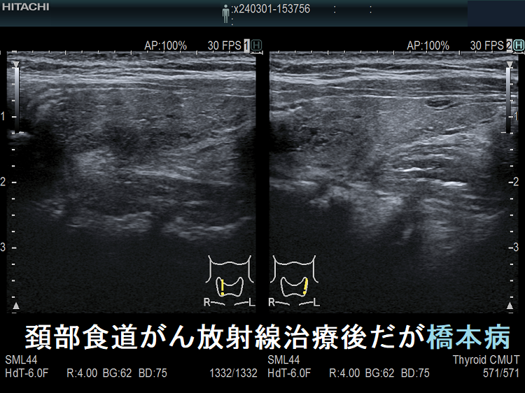 頚部食道がん放射線治療後だが橋本病(縦断) 頚部食道がん放射線治療後だが橋本病(縦断)
