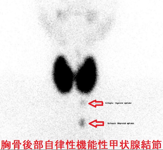 胸骨後部自律性機能性甲状腺結節 胸骨後部自律性機能性甲状腺結節