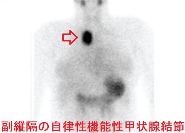 副縦隔の自律性機能性甲状腺結節 副縦隔の自律性機能性甲状腺結節