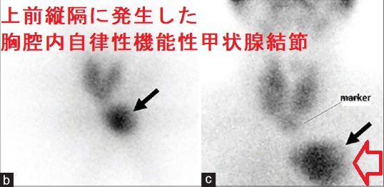 上前縦隔に発生した胸腔内自律性機能性甲状腺結節 上前縦隔に発生した胸腔内自律性機能性甲状腺結節
