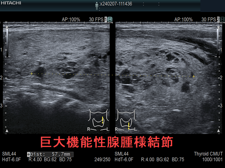 巨大機能性腺腫様結節(縦断) 巨大機能性腺腫様結節(縦断)