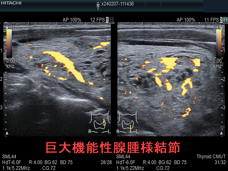 巨大機能性腺腫様結節(縦断) ドプラーモード 巨大機能性腺腫様結節(縦断) ドプラーモード